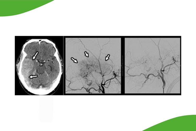Grafik aus drei Bildern: Prä-operative Embolisation eines großen Meningeoms mit Einbruch in den venösen Sinus. Nach der  Partikel- und Kleber-Embolisation ist der Tumorblush (Pfeile) nahezu vollständig ausgeschaltet. Die  anschließende neurochirurgische Operation mit vollständiger Tumorentfernung war problemlos und  ohne wesentlichen Blutverlust möglich.   