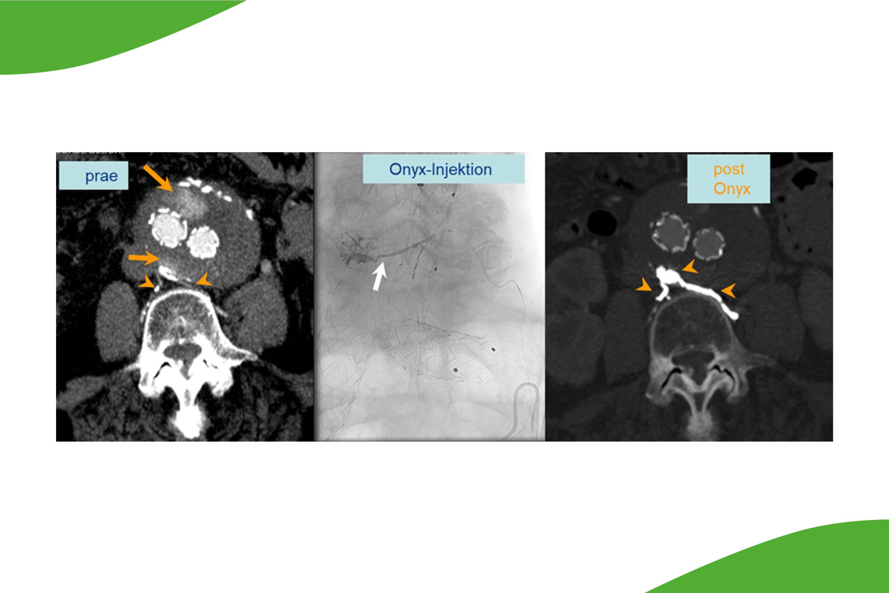 Nicht barrierefrei: Grafische Darstellung dreier Bilder mit Beschriftung (prae, Onxy-Injektion, Post Onxy) der sogenannten EVAR Repair. 