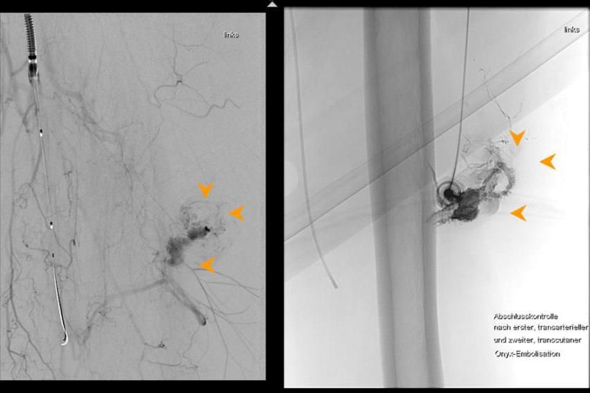 Ausschaltung mit transarterieller und transcutaner Onyxembolisation. Danach ist die Malformation ausgeschaltet. Der Patient war dann beschwerdefrei.