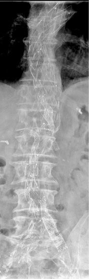 Komplexe Rekonstruktion der thorakalen und abdominellen Aorta mittels mehrerer patientenindividuell angefertigter Stentgraftsysteme mit Seitenfenstern (FEVAR). Alle Bauchgefäße sind mit einzelnen Fenstern versorgt worden. Das System reicht bis beidseits in die Beckenarterie hinein. 