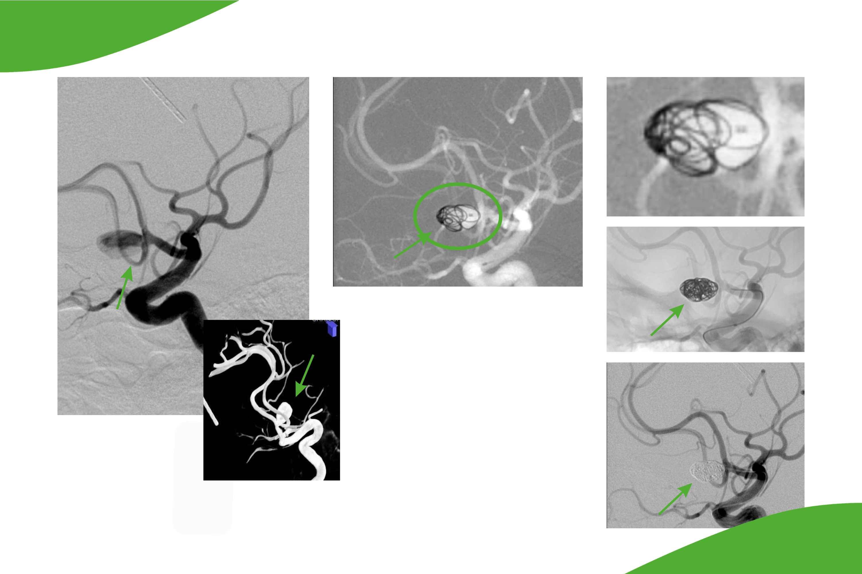 Interventionelle Behandlung eines Hirnarterienaneurysma der Arteria communicans anterior mittels Coiling.