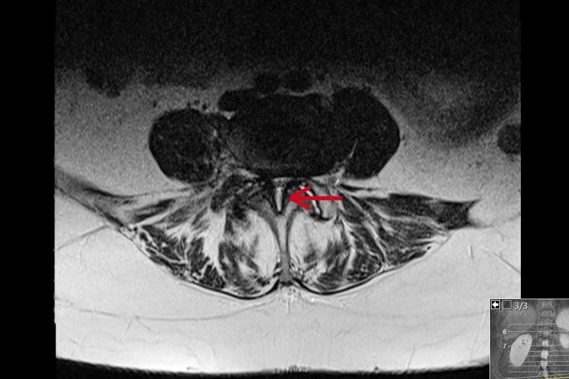 Schlitzförmige Einengung des Spinalkanals