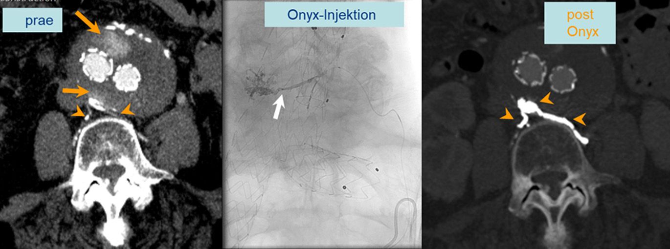 EVAR Repair (links) bei sog. Endoleak u.a. über Lumbalgefässe (Pfeilspitzen) und großer Kontrastmittelansammlung im Aneurysmasack (orange Pfeile links) mit deutlichem Größenwachstum des Aneurysmasackes trotz Endograft (extern vor mehreren Jahren). Onyx-Injektion (Mitte) mit Mikrokatheter am Aneurysmasack (weißer Pfeil), Okklusion des Endoleaks und beider Lumbagefässmündugnen mit dem Onyx-Cast über eine Mikrokatheterposition. In der CT Kontrolle ist das Embolisat in den ehemaligen Zuflüssen gut erkennbar.