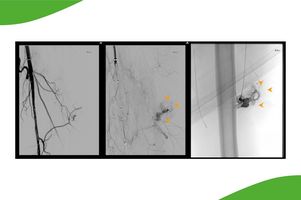 Grafische Darstellung einer Gefäßmalformation am Oberarm.Ausschaltung mit transarterieller und transcutaner Onyxembolisation. Danach ist die Malformation ausgeschaltet. Der Patient war dann beschwerdefrei.