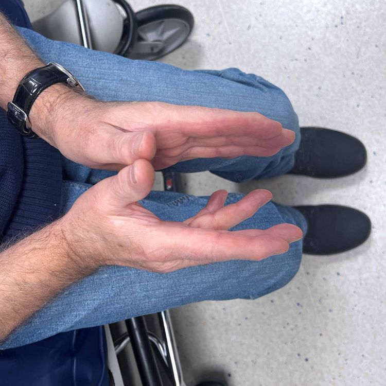 Foto der Hände eines Patienten mit Morbus Dupuytren im Untersuchungs- und Behandlungszentrum im Klinikum Saarbrücken