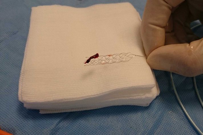 So sieht ein Thrombus aus, der ein hirnversorgendes Gefäß verstopft und somit einen Schlaganfall ausgelöst hat. Mit dem Stent-Retriever wird er via Katheter im Rahmen einer Thrombektomie entfernt. 