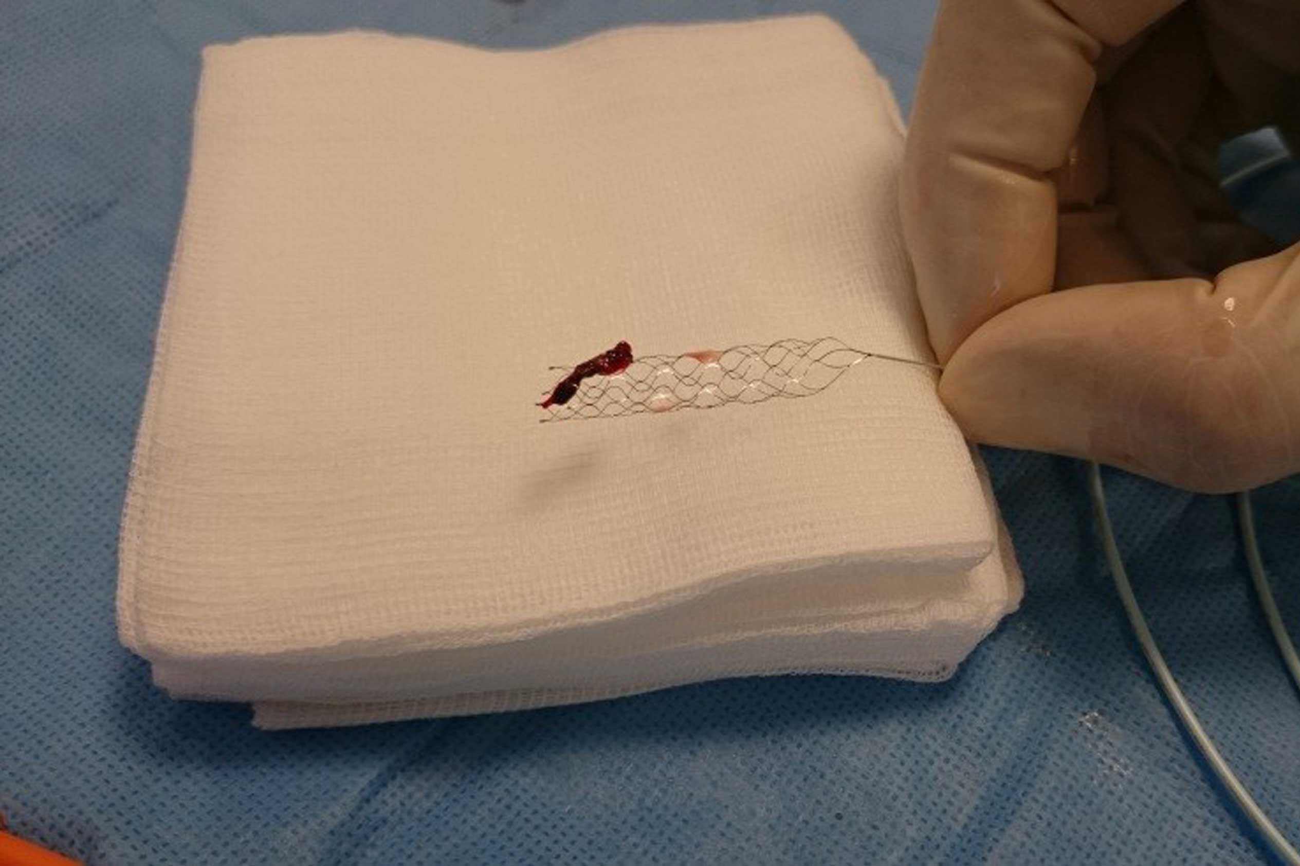 So sieht ein Thrombus aus, der ein hirnversorgendes Gefäß verstopft und somit einen Schlaganfall ausgelöst hat. Mit dem Stent-Retriever wird er via Katheter im Rahmen einer Thrombektomie entfernt. 