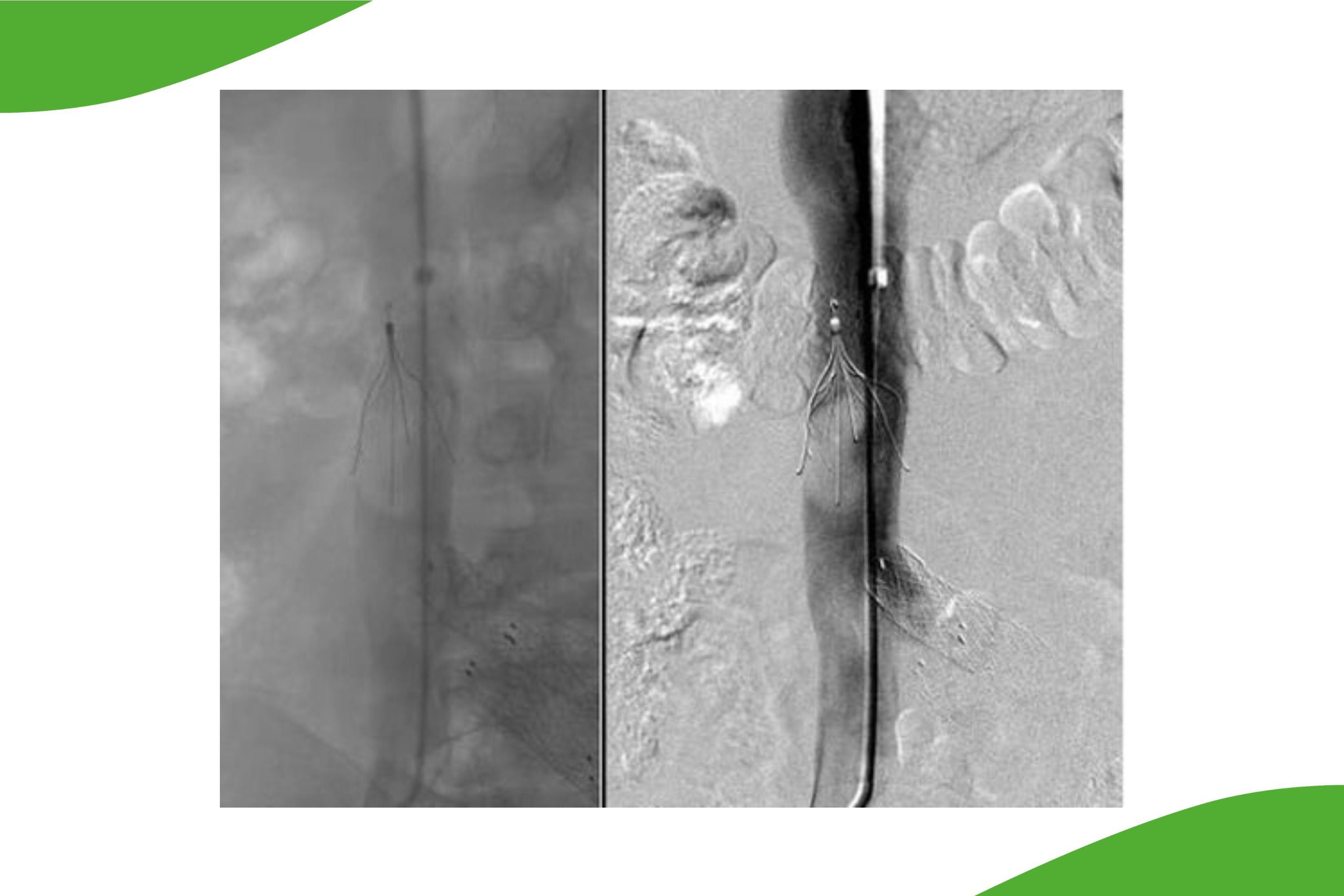 Grafische Darstellung eines Verschlusses (Embolus) in einem sogenannten Cavafilter. 