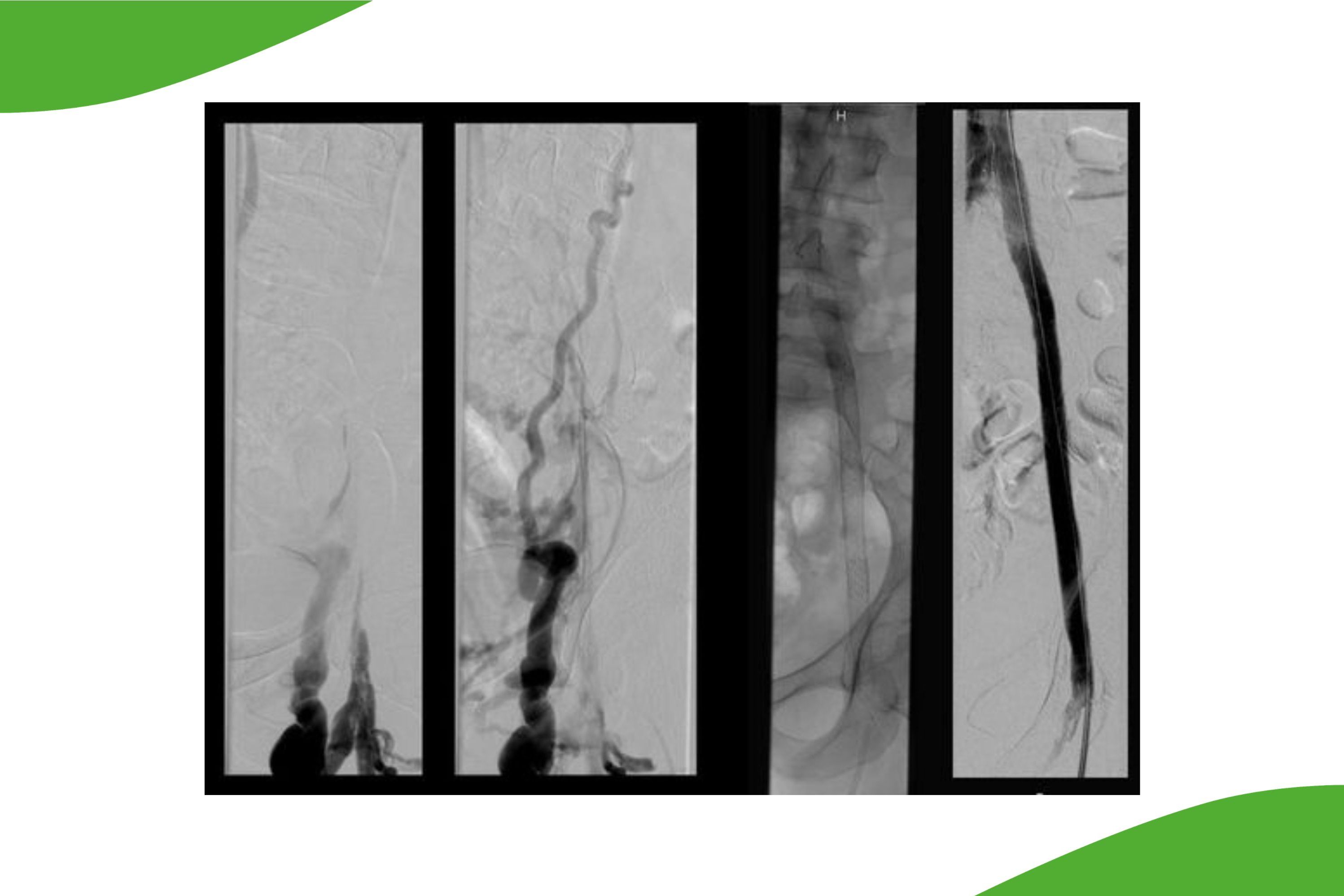 Grafische Darstellung eine Beckenvenenverchlusses bei posthrombotischem Syndrom