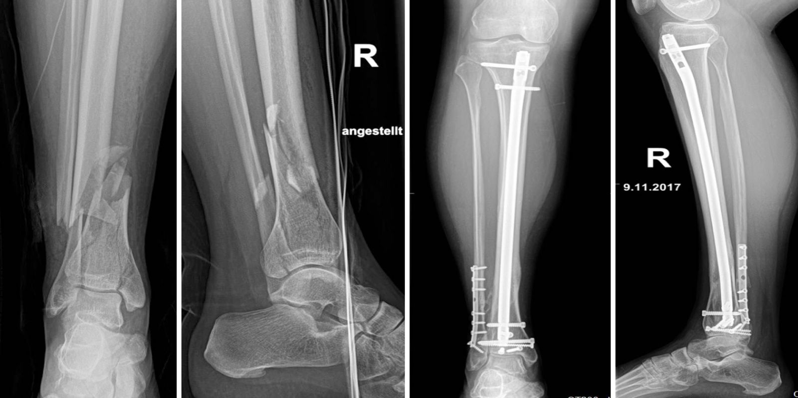 Alle unfallchirurgischen Verfahren der Notfallversorgung stehen zur Verfügung - z. B. mittels Fixateur externe, als auch moderne definitive Osteosynthese-Verfahren mittels Plattenosteosynthese oder Nagelosteosynthese sowie minimalinvasive Methoden. 