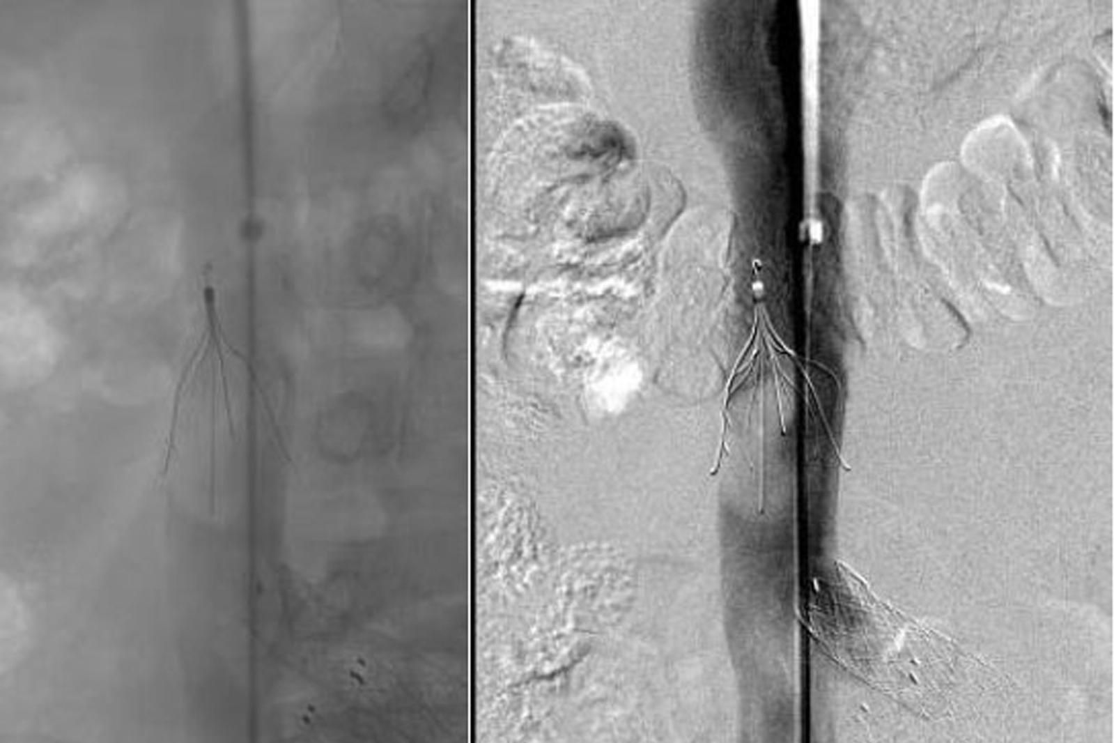 Großer Embolus, gefangen in einem Cavafilter (Pfeil). 
Links: native, rechts: DSA-Aufnahme. Schrägeinstellung, um die Überlagerung mit dem Kolon zu vermeiden
