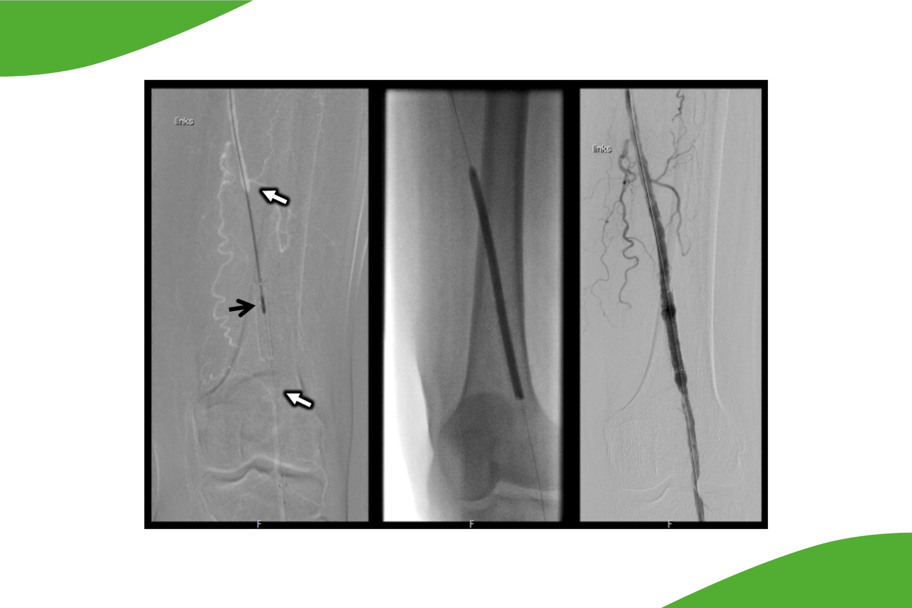 Grafische Darstellung der Oberschenkelarterie, links mit Verschluss (weiße Pfeile) und der Katheterintervention (schwarzer Pfeil)
