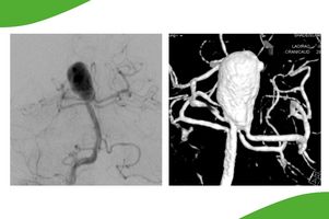 Grafik radiologischer Aufnahmen eines großen Hirnaneurysma im Bereich der Arteria basilaris (sogenanntes Basilariskopf-Aneurysma), welches durch die raumfordernde Wirkung symptomatisch geworden ist