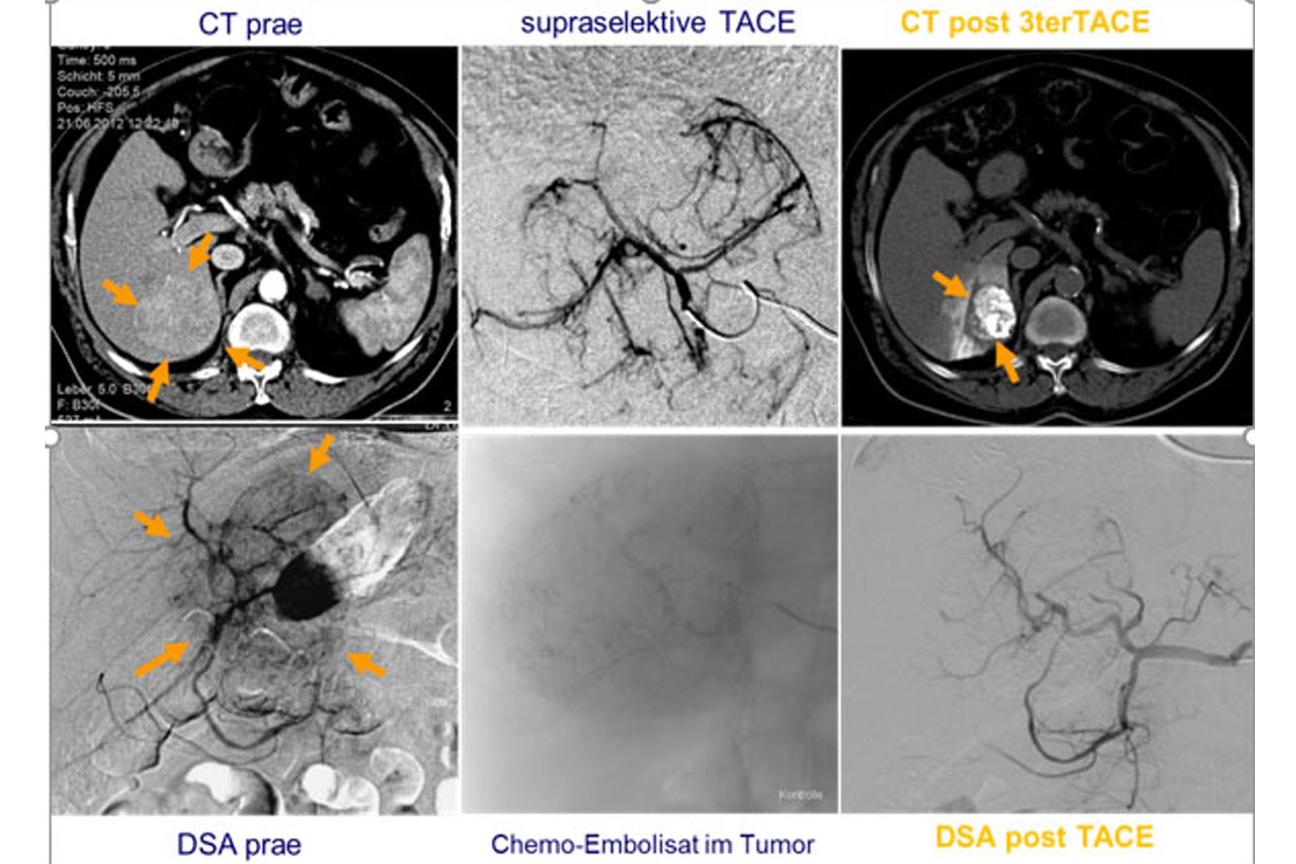 Abbildung: TACE bei HCC. Das Chemoembolisat reichert sich gut im Tumor an. Nach drei Sitzungen ist das Leberzellkarzinom deutlich geschrumpft