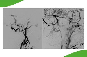 Grafiken einer Angiographie der Gesichtsarterie mit Darstellung einer komplexen Kurzschlussverbindung zwischen Arterien und Hirnvenen (sog. durale AF-Fistel)
