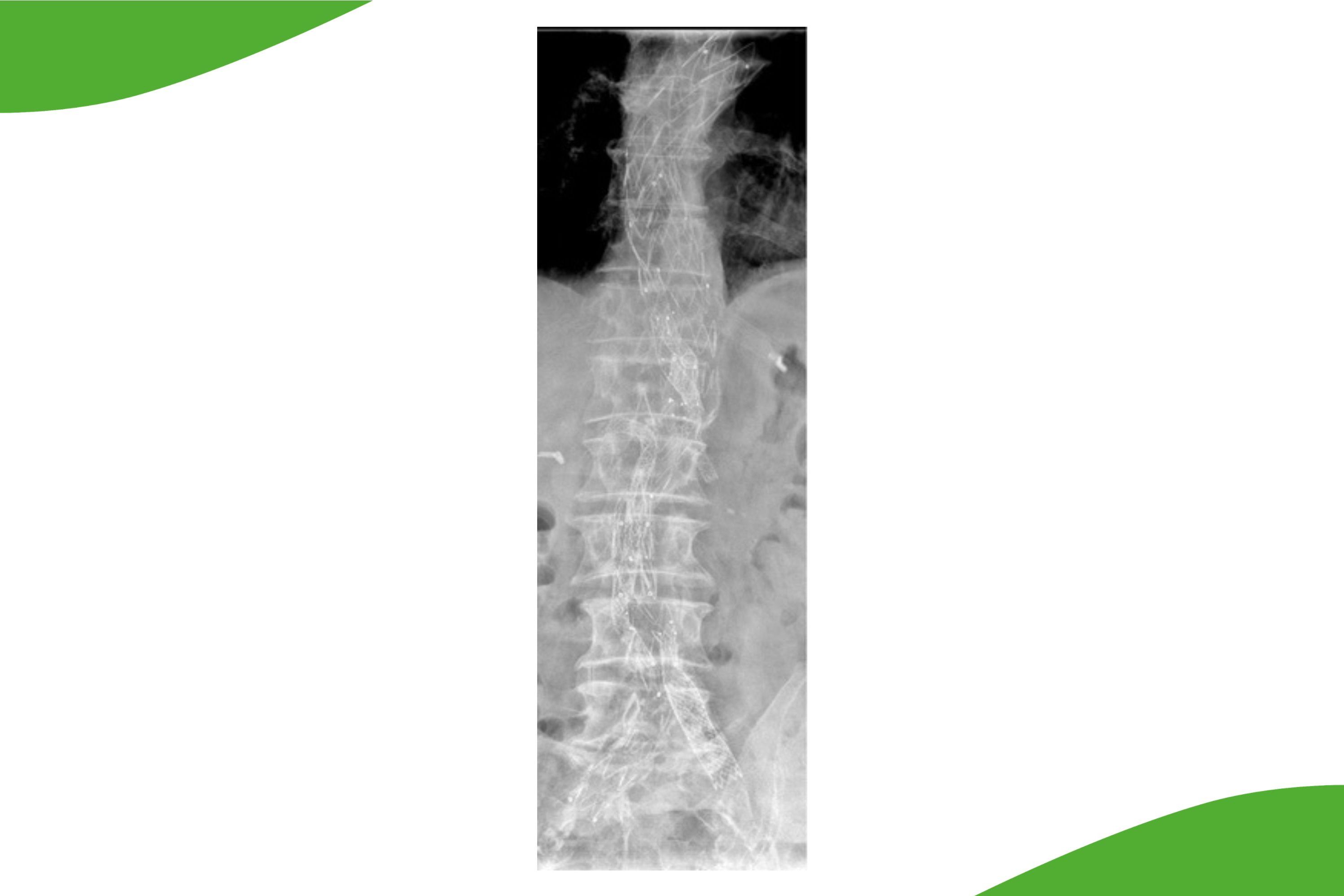 Grafische Darstellung der komplexen Rekonstruktion der thorakalen und abdominellen Aorta mittels mehrerer patientenindividuell angefertigter Stentgraftsysteme mit Seitenfenstern (FEVAR).