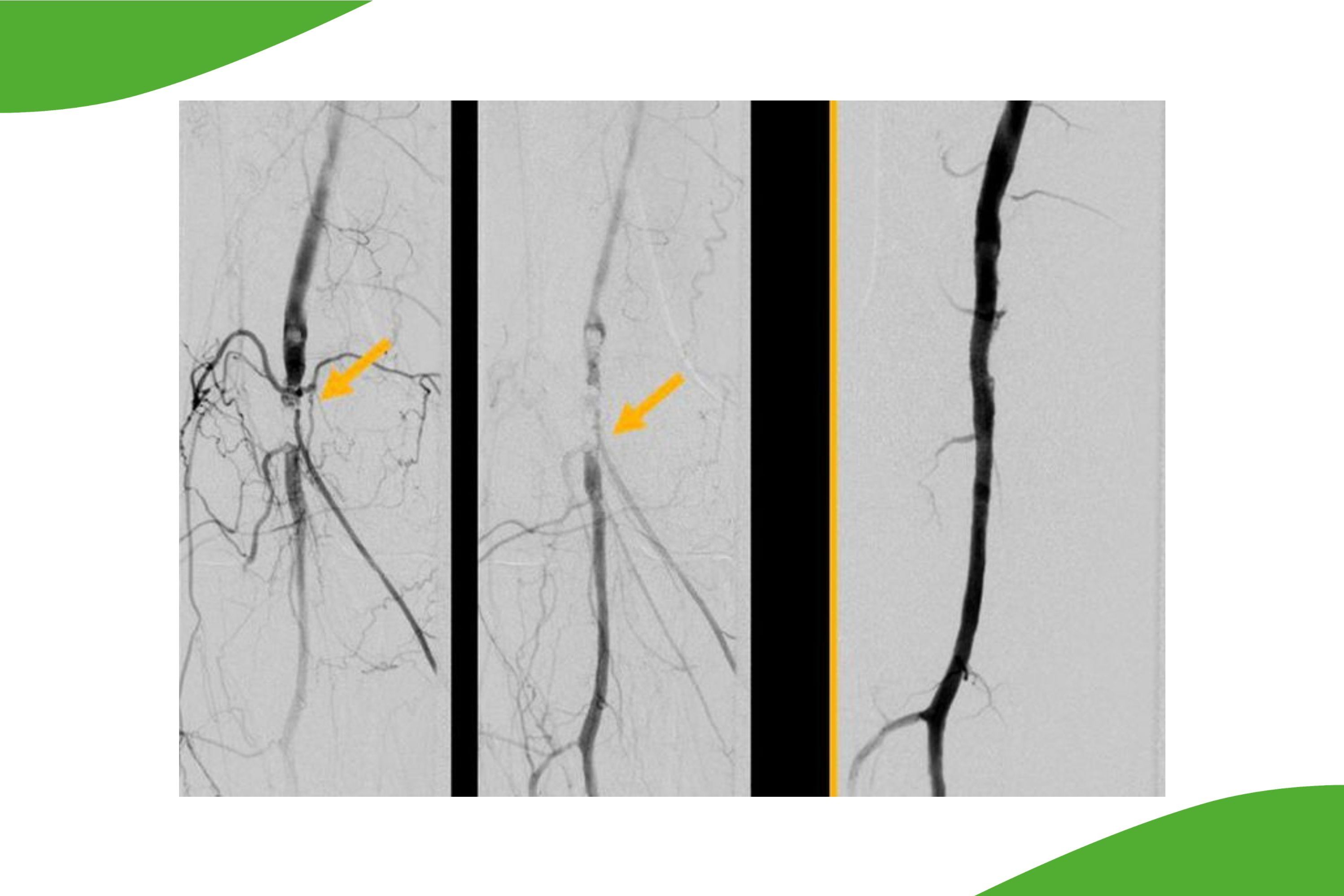 Grafische Darstellung eines Verschlusses einer Kniegelenksarterie (links). Im rechten Bild ist der Stent-PTA ersichtlich. 