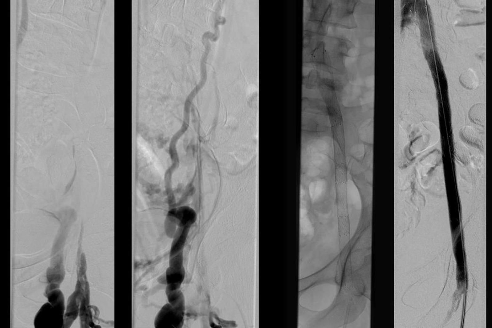 Rekanalisation eines alten Beckenvenenverschlusses bei posthrombotischem Syndrom. Links DSA-vor dem Eingriff,  rechts wiedereröffnete Beckenvenen nach Stent-PTA.