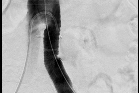 Ausschaltung durch Stentgraft