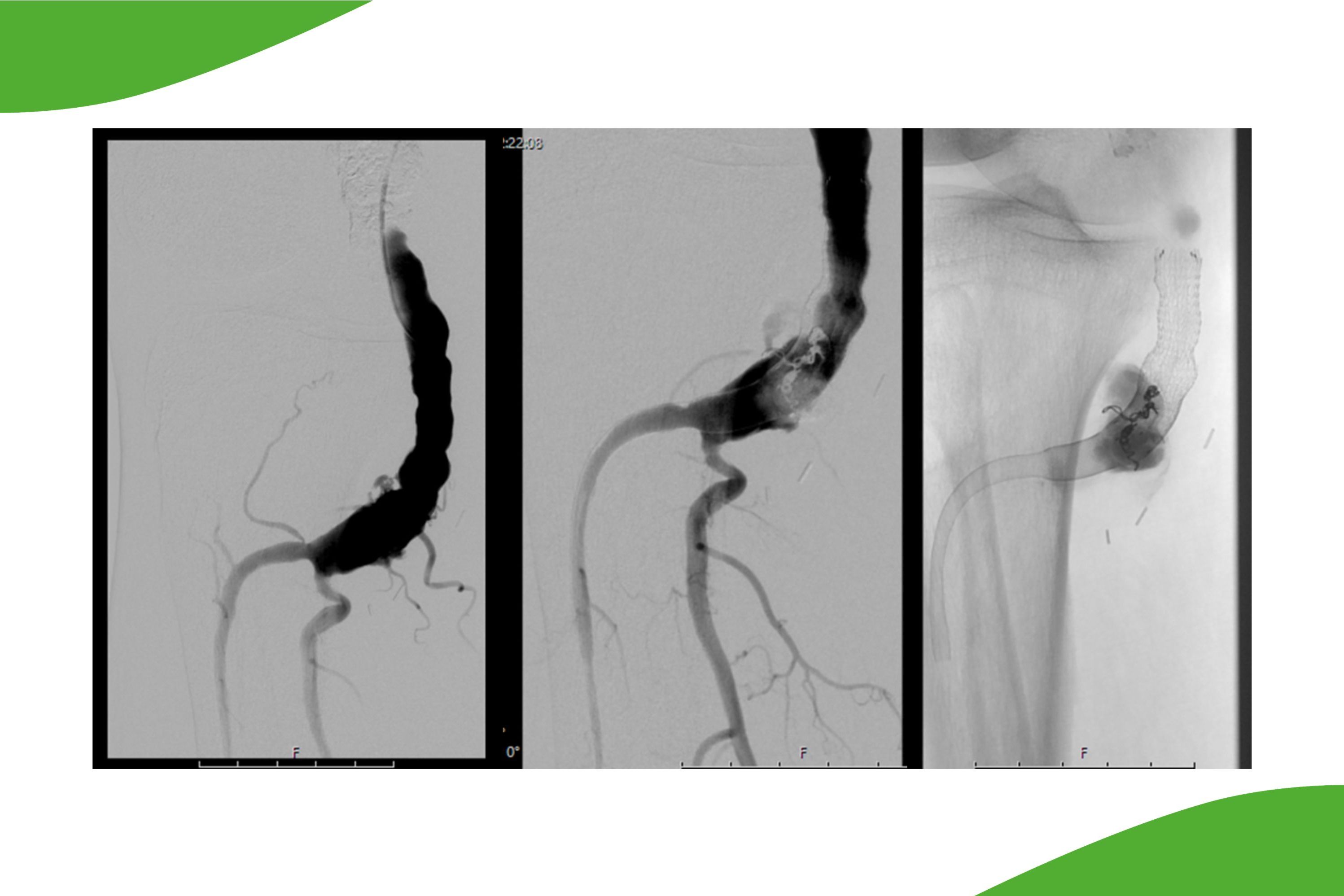 Grafische Darstellung eines Aneurysma der Arteria poplitea bis in die Trifurkation am Unterschenkel reichend. Im mittleren und rechten Bild sieht man die Versorgung mit zwei verschachtelten Flowdivertern und dann Verlängerung nach proximal mit einer Viabahn-Prothese. 