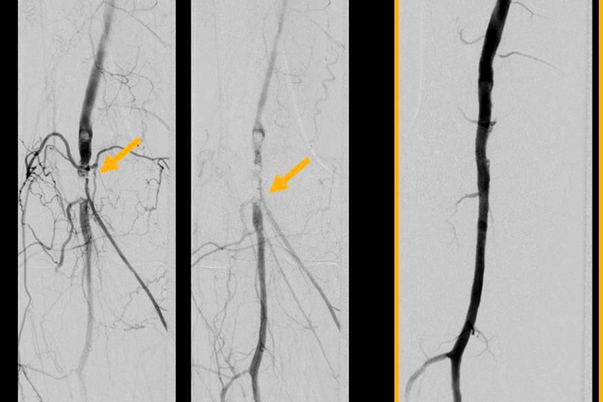 Links: Verschluss der Kniegelnksarterie (Pfeile). Erst in den Spätaufnahmen füllen sich die Unterschenkelgefässe. Klinisch lag eine kritische Durchblutungsstörung vor. Geeignetes körpereigenes Ersatzmaterial (Venen) für einen Bypass lag nicht vor, ferner reduzierte OP-Fähigkeit. 
Die  Rechts: Stent-PTA mit gewebtem Stent. Die alleinige Dilatation hatte keine ausreichennde Aufweitung ergeben. Nach Implantation eines gewebten Stentes sehr gute Gefässrekonstruktion.
Die Beschwerden waren rasch rückläufig.