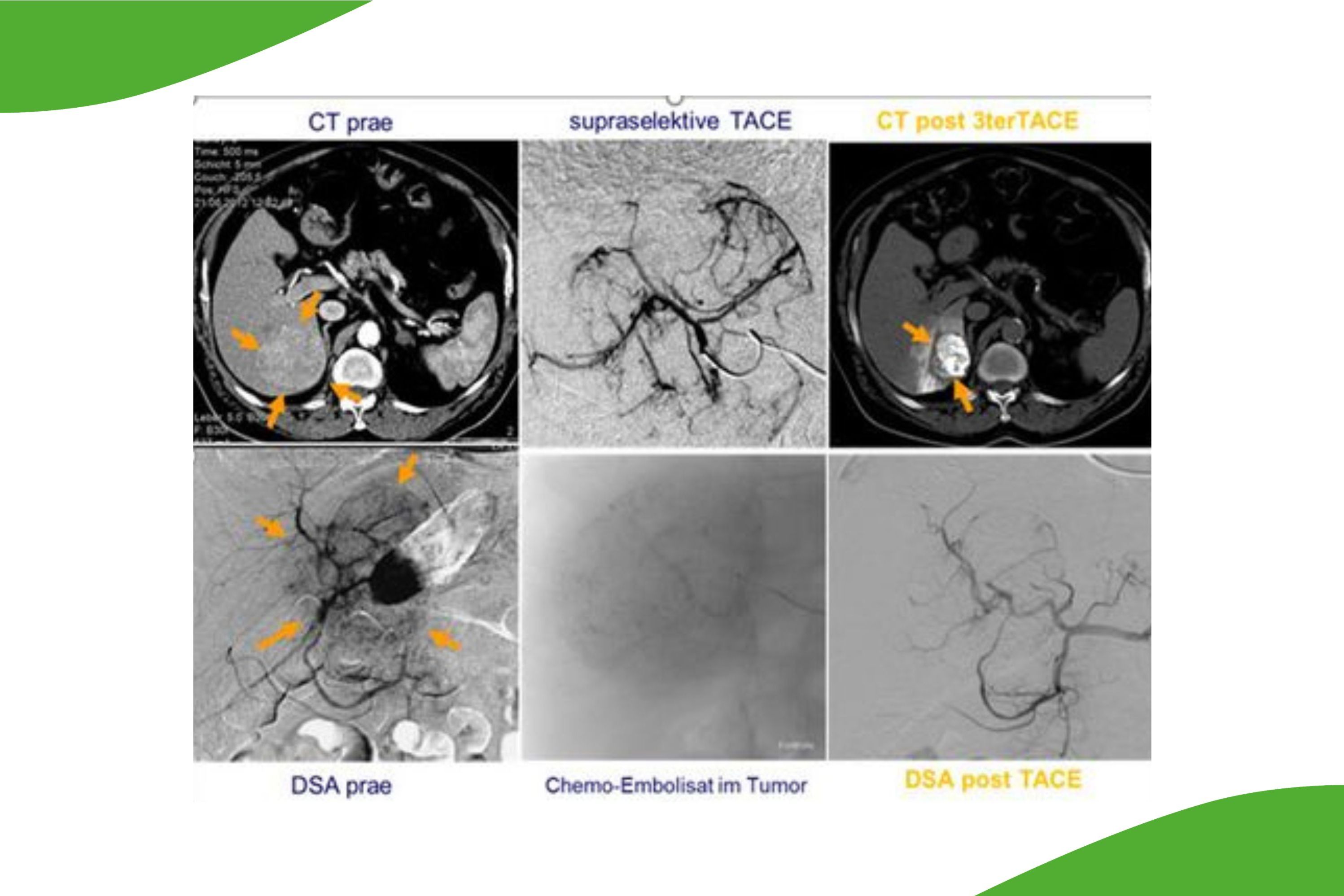 Nicht barrierefrei: Die grafische Darstellung zeigt in sechs Bildern den Verlauf einer transarterielle Chemoembolisation beim Leberkarzinom. 