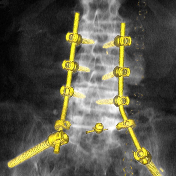 Bildgebung CT: Stabilisierung einer beiderseitigen kompletten Kreuzbeinfraktur mittels sogenannter lumbopelviner Abstützung.