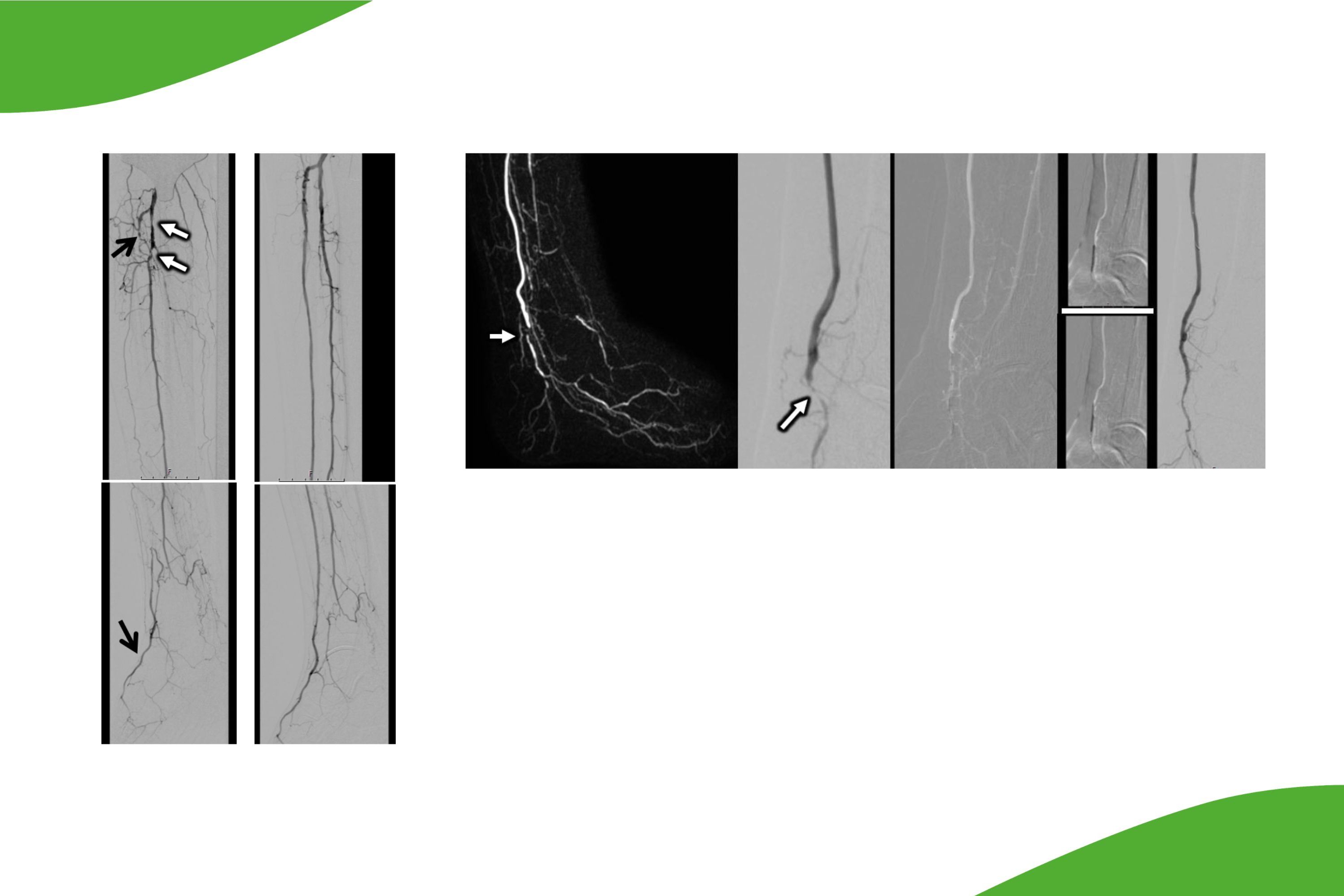 Gefäßdarstellungen nach Stentimplantatioen der Unterschenkelgefäße. 