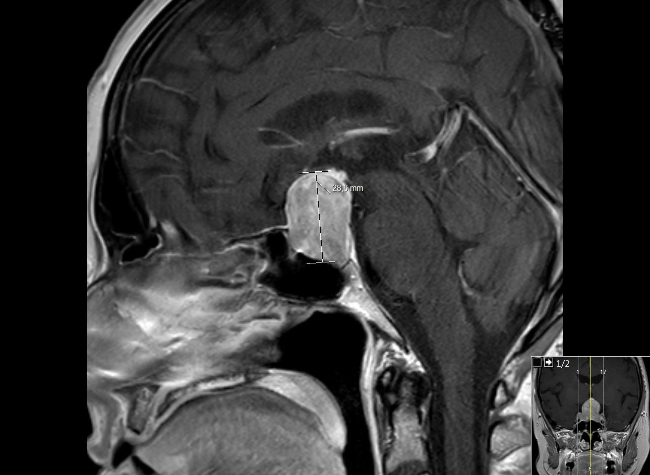 Großes intra- und suprasellär gelegenes Hypophysenadenom im sagittalen Schnitt