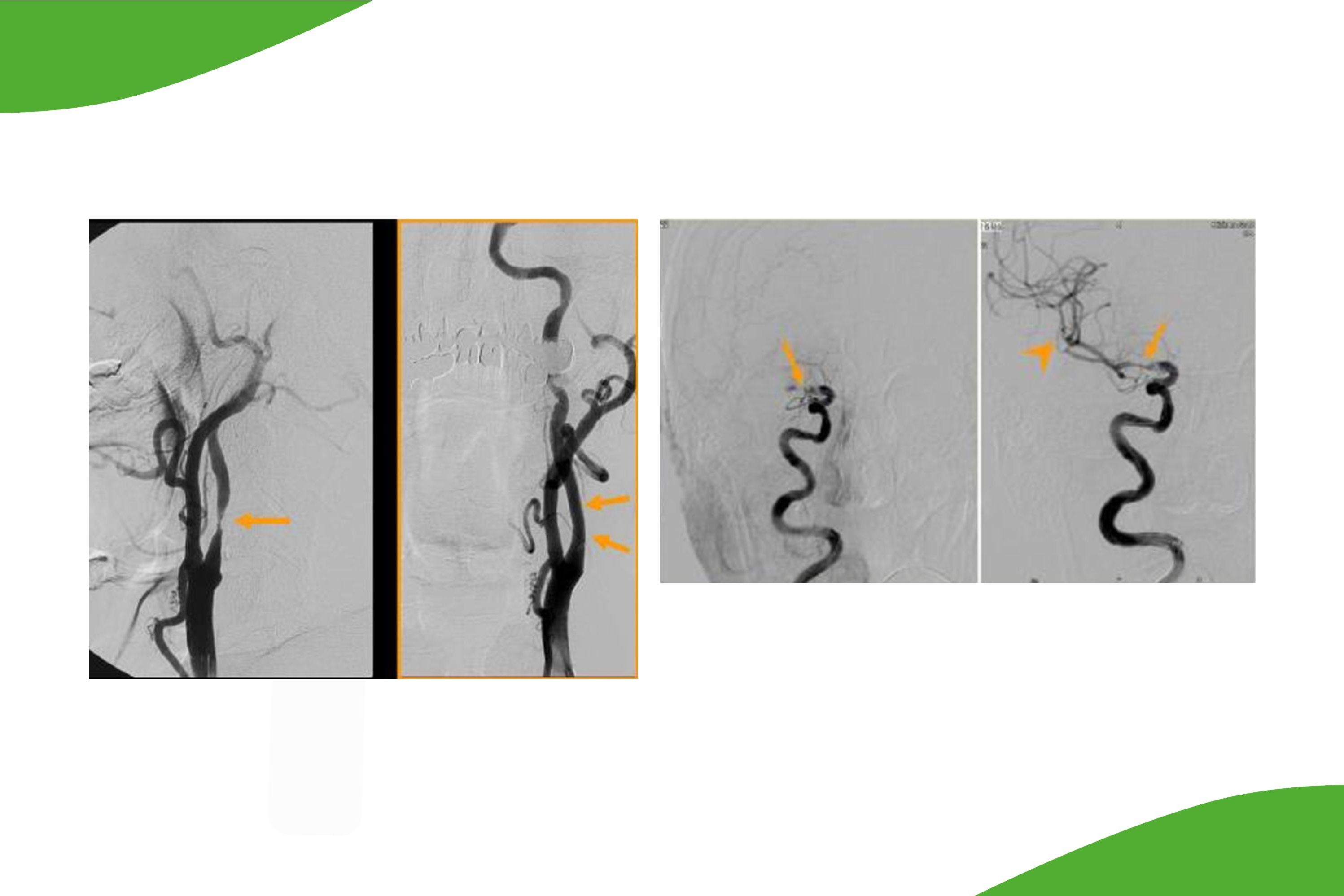 Vier Grafiken: . Wiedereröffnung von Hirnarterien und Erweiterung von extra- und auch intracraniellen Gefäßen