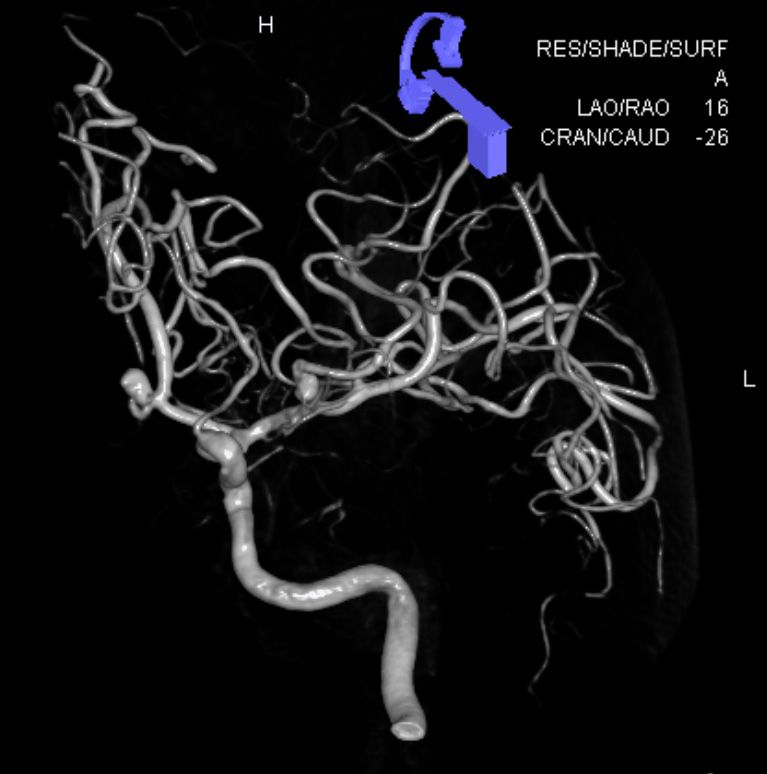 Ein Aneurysma ist eine Aussackung eines Blutgefässes im Gehirn