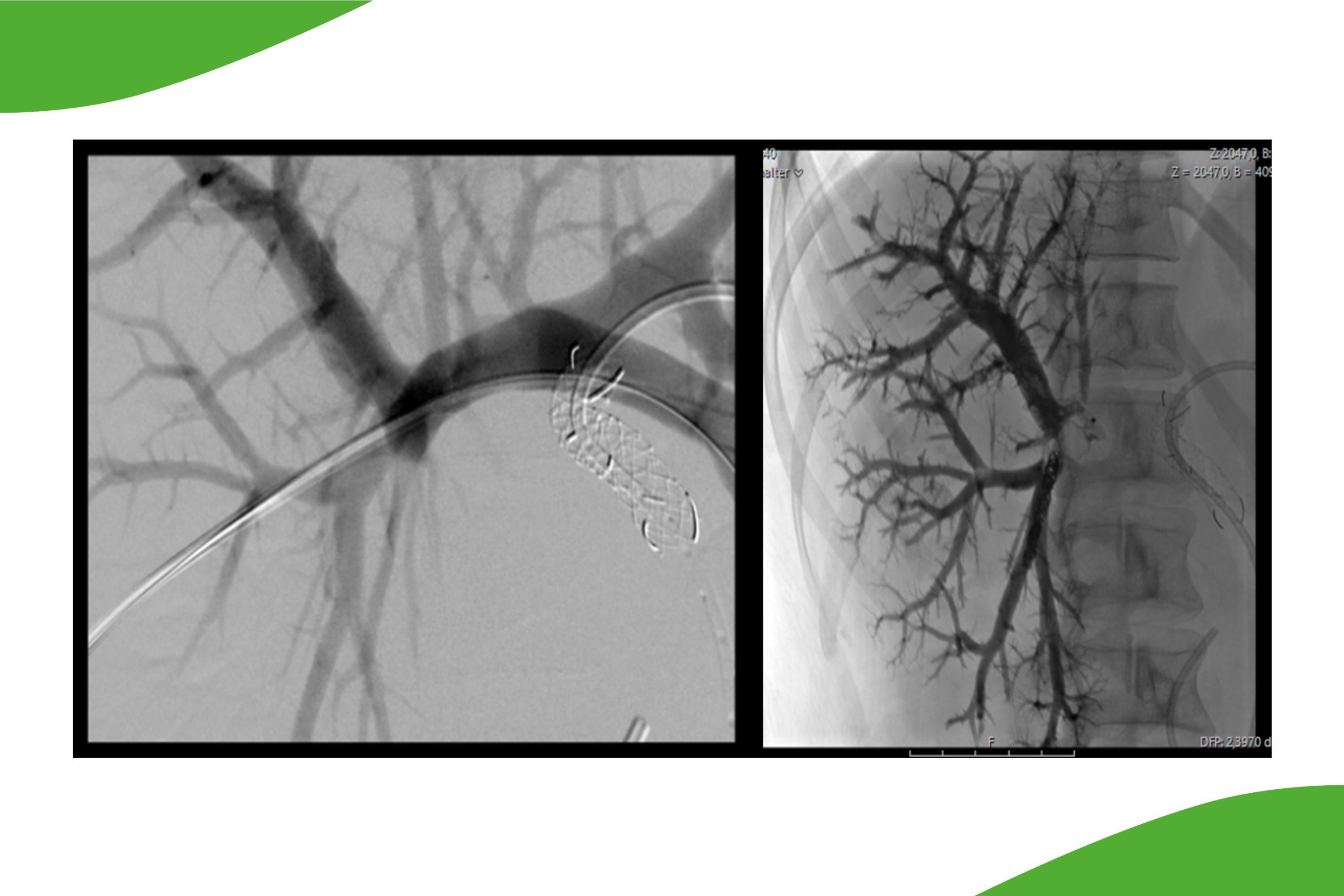 Grafische Darstellung in zwei Bildern einer Lebervenen-Embolisation. Das gesamte Gefäßbett des rechten Pfortadersystems wurde mit Kleber embolisiert. Dazu wurde zentral ein sogenannter Plug implantiert.  