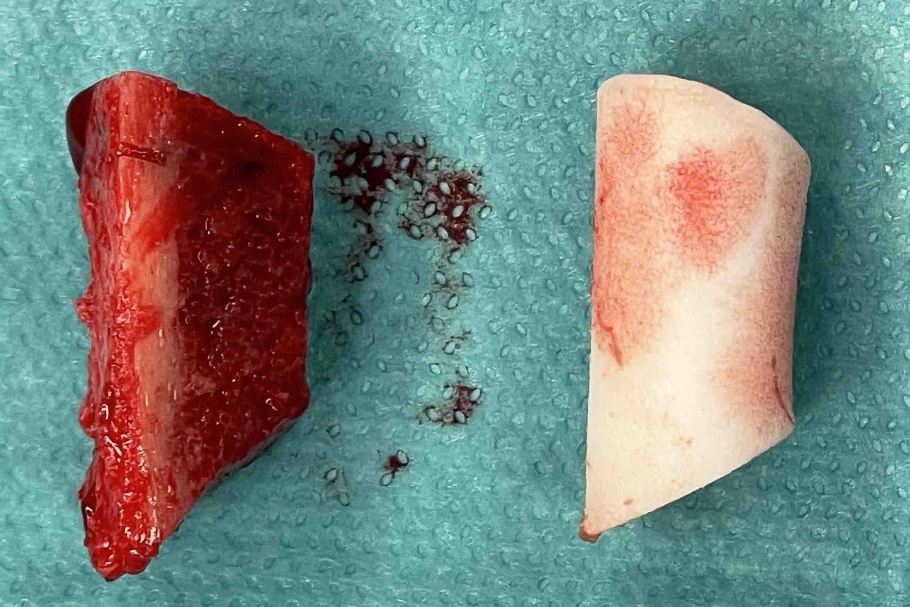 Das Bild zeigt ein Knochentransplantat aus dem Becken.