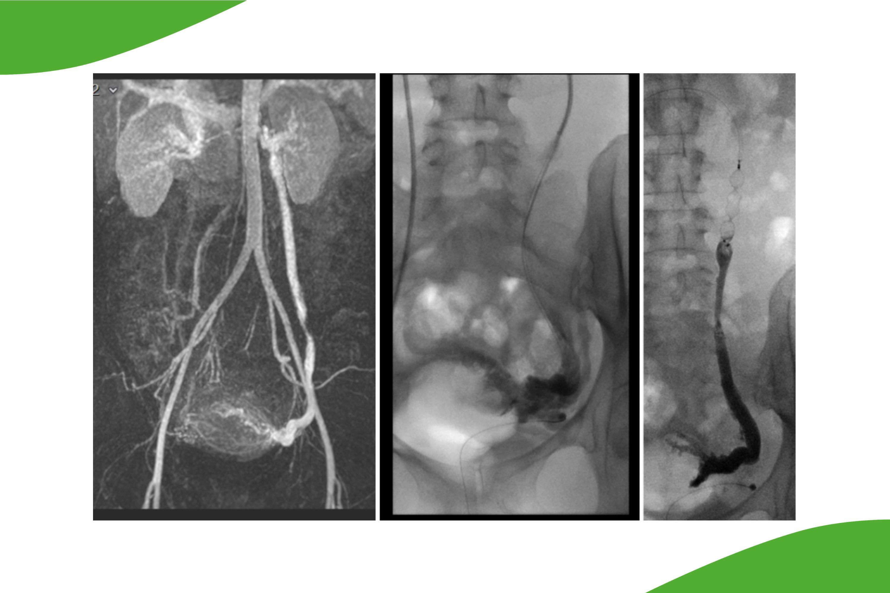 Grafische Darstellung einer Embolisation einer insuffizienten linken Vena ovarica bei pelvinem Kongestions-Syndrom (PCS). 