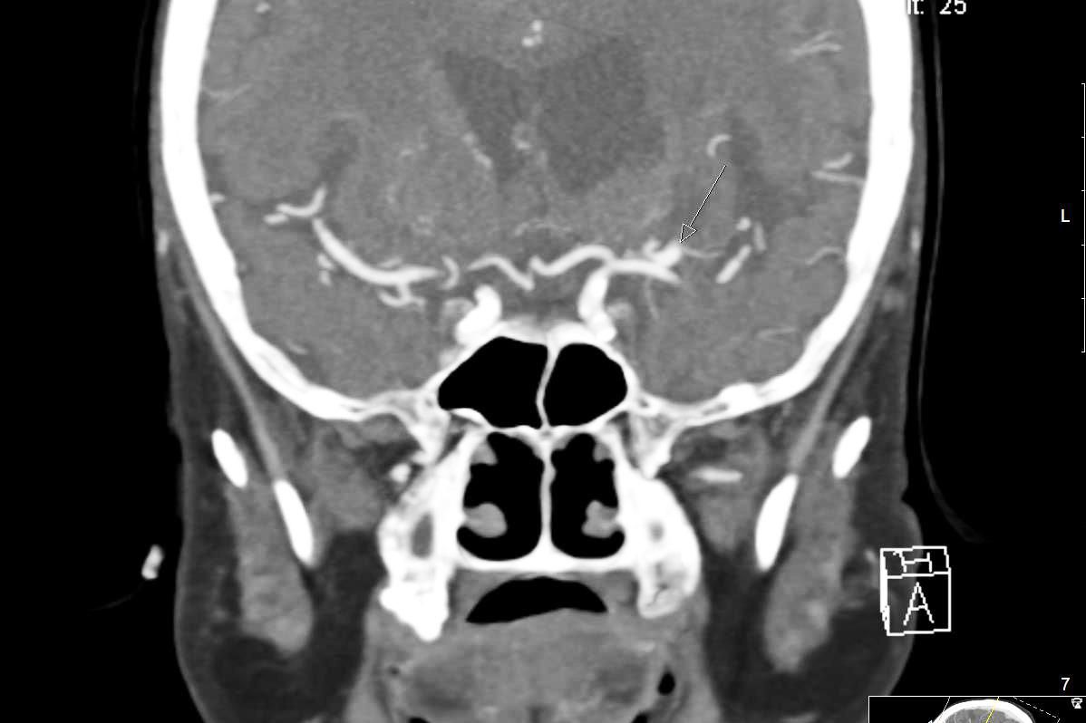 Intrakranielles Aneurysma in der CTA. Koronare Rekonstruktion.