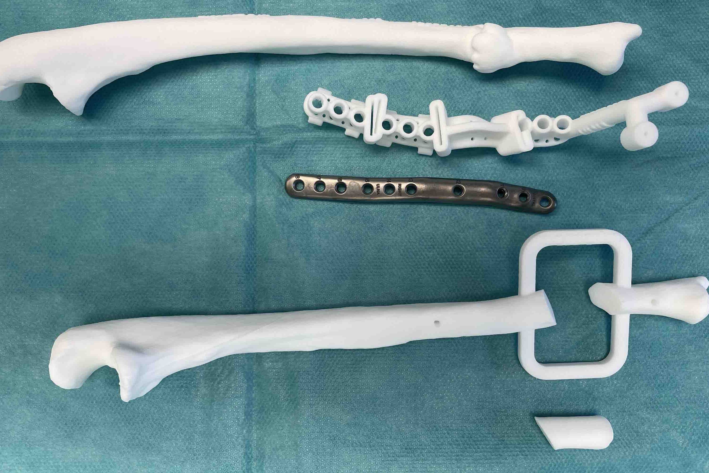 Das Bild zeigt ein individuelles Implantat mit Bohr- und Säge-Schablone sowie den dazu gehörigen 3D-Modellen der fehlverheilten Elle und der operativen Korrektur