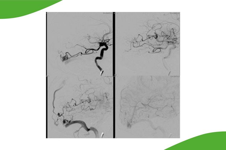 Grafik aus vier Bildern: Atypische Hirnblutung bei AV Malformation (Angiom). Ursächlich für  die Blutung waren die Veränderungen  der drainierenden Brückenvene.  Embolisation mit Flüssigembolisat und  Gewebekleber. Danach ist das  Angiom ausgeschaltet, die Venen füllen sich zeitgerecht.  