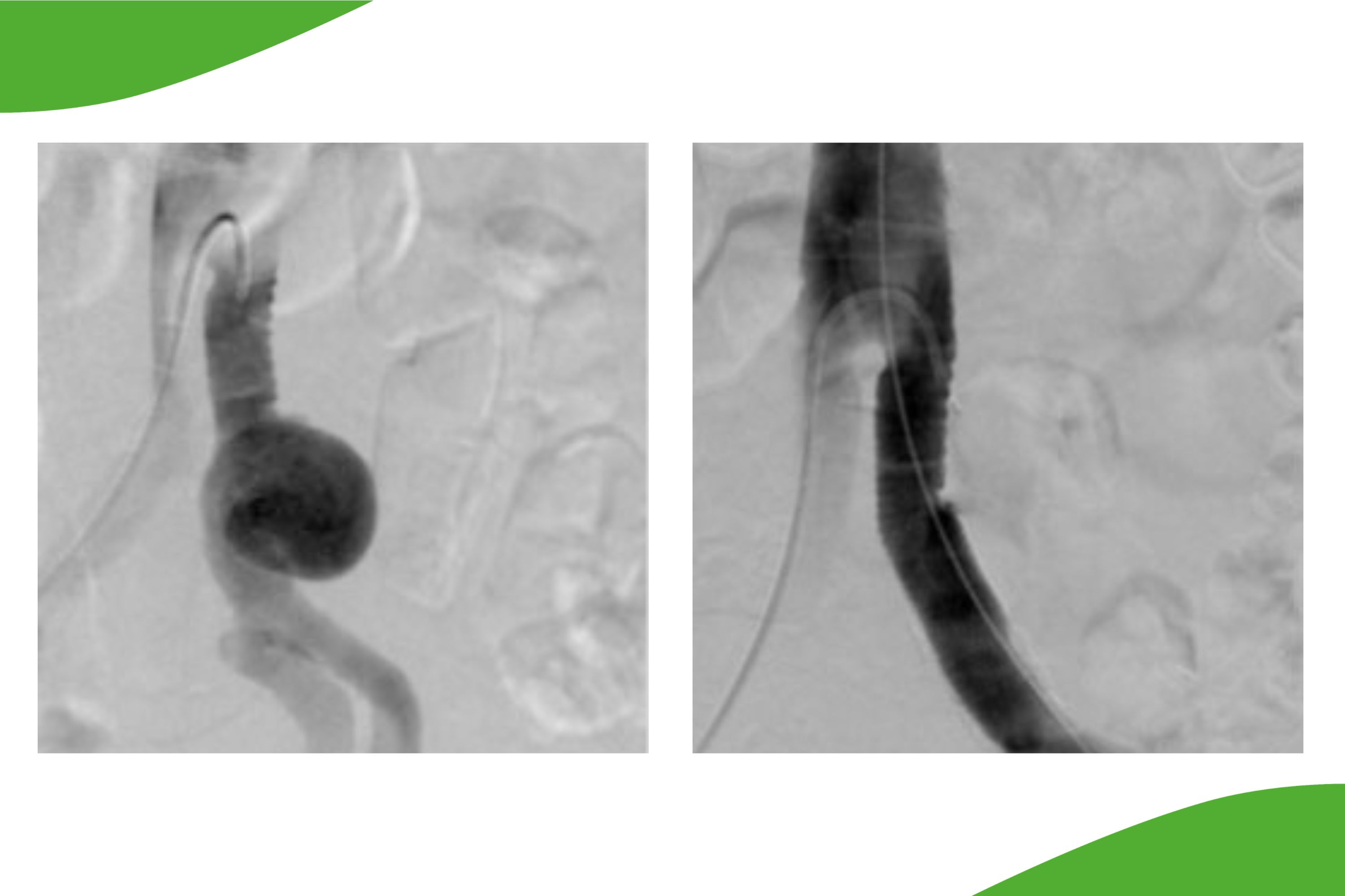 Grafische Darstellung eines Anschlussaneurysma nach Y-Prothese (Bild links) und einer Ausschaltung durch Stentgraft (rechts).