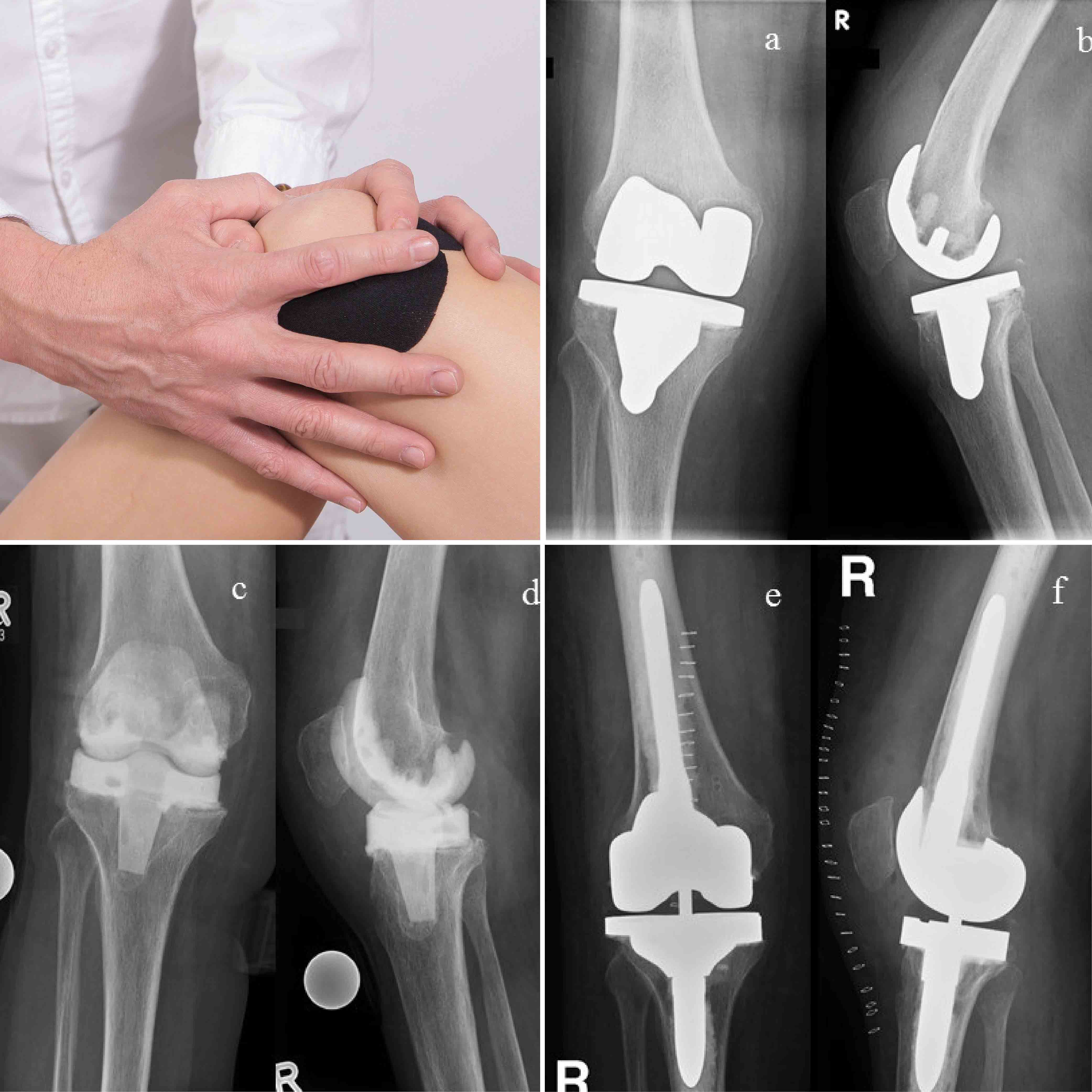 Collage: Röntgenaufnahmen infizierter Knie-Endoprothese